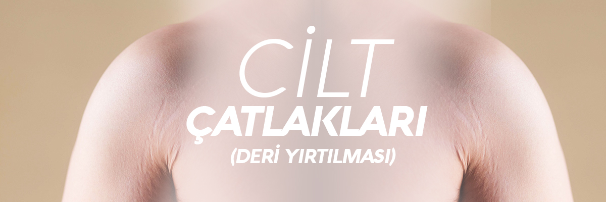 Cilt Çatlakları Cilt Çatlakları