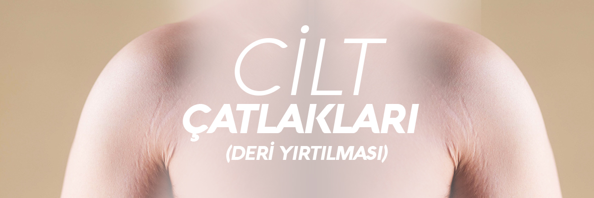 Cilt Çatlakları